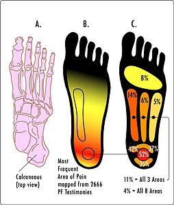 https://upload.wikimedia.org/wikipedia/commons/thumb/b/ba/PF-PainAreas.jpg/254px-PF-PainAreas.jpg